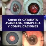 Curso Catarata Avanzada, Compleja y Complicaciones