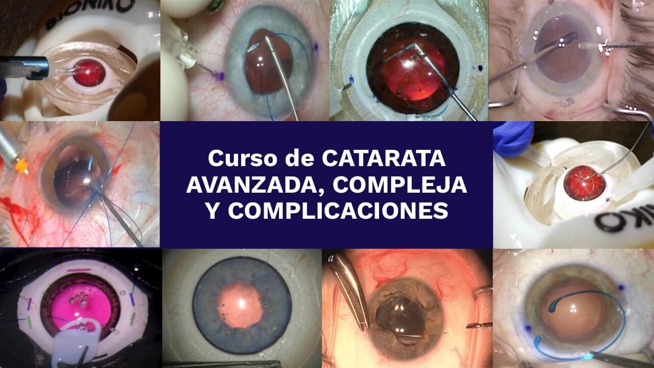 curso catarata compleja